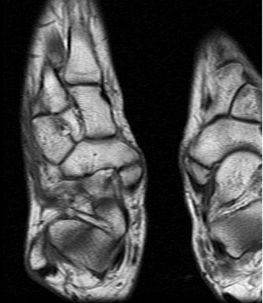Accessory Navicular Bone In Foot