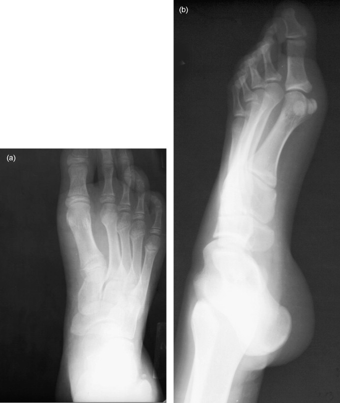 Accessory Navicular Bone In Foot