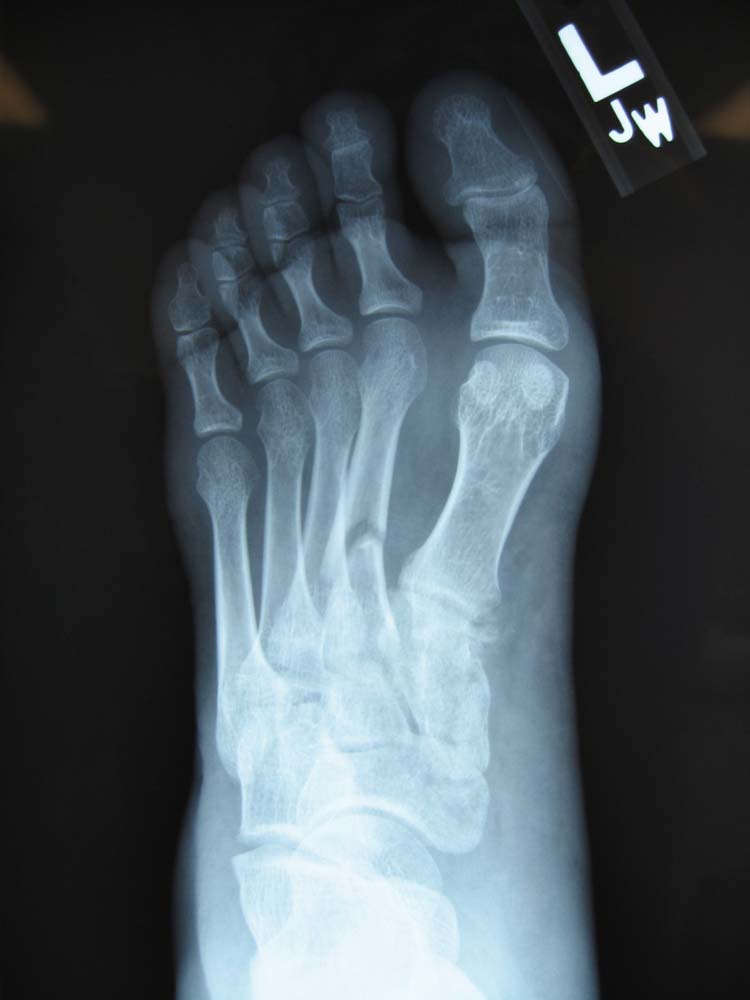 Accessory Navicular Surgery Complications