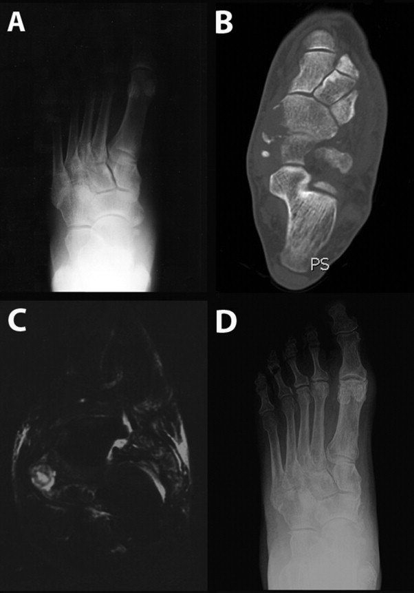 Accessory Navicular Surgery Complications