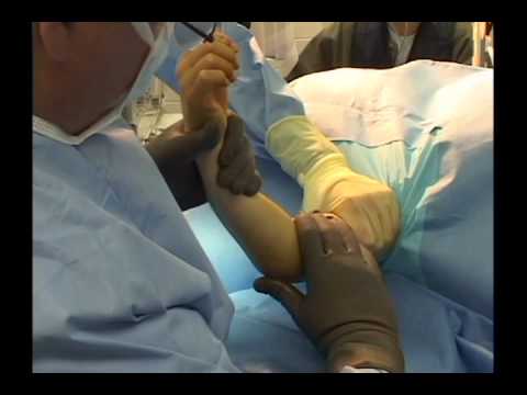 Accessory Navicular Surgery Video