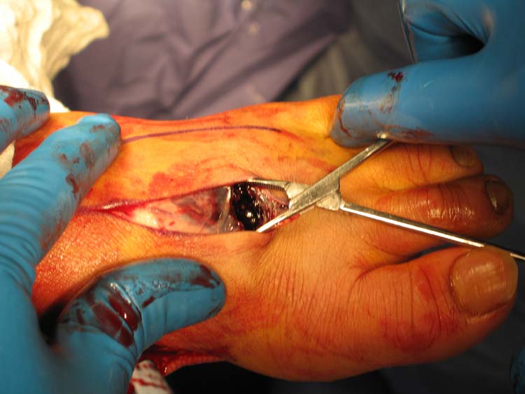 Accessory Navicular Surgery Video