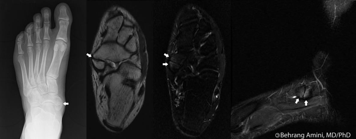 Accessory Navicular Syndrome Mri