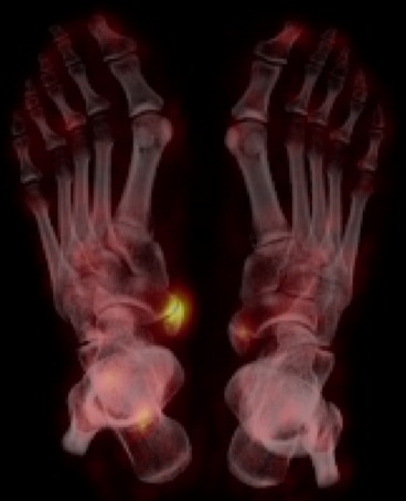 Accessory Navicular Syndrome Mri