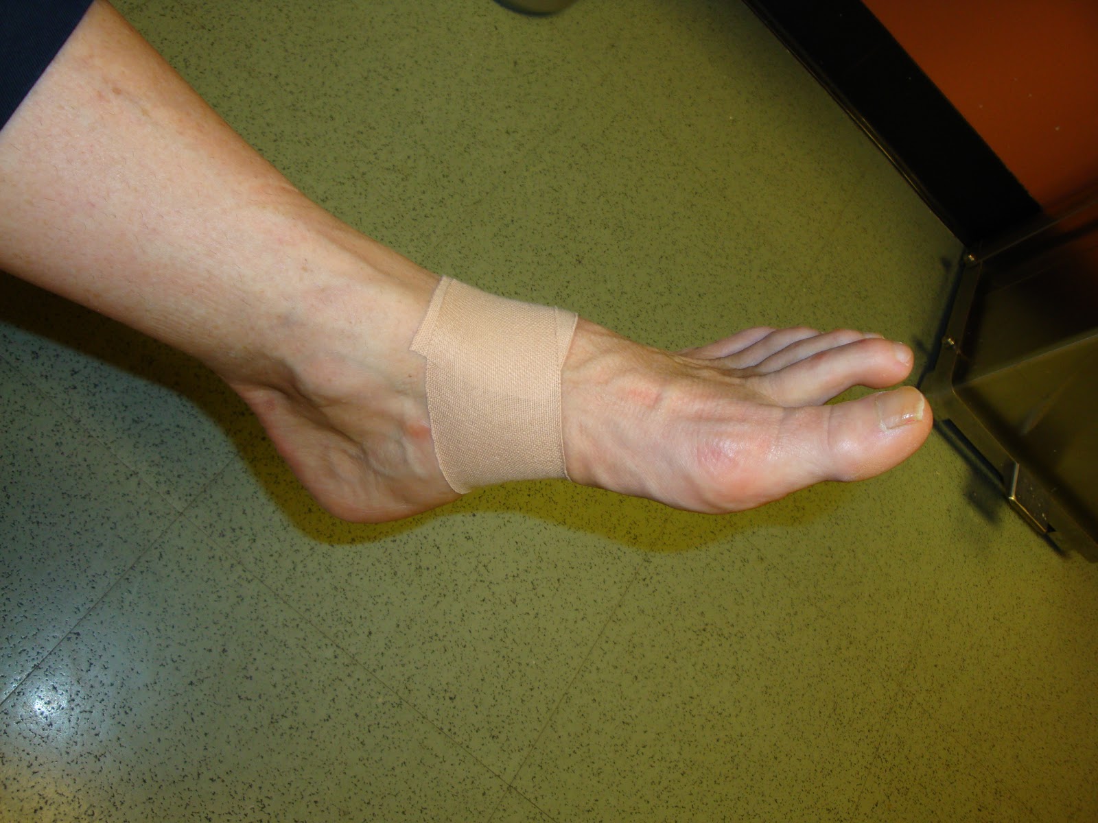Accessory Navicular Syndrome Running