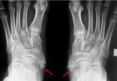 Accessory Navicular Syndrome Running