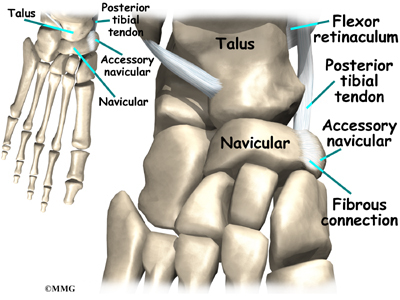 Accessory Navicular Syndrome Surgery Recovery