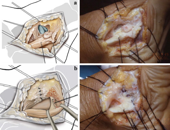 Accessory Navicular Syndrome Surgery Recovery