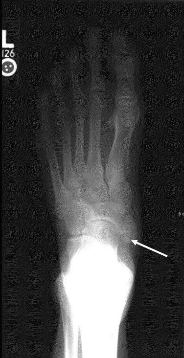 Accessory Navicular Types