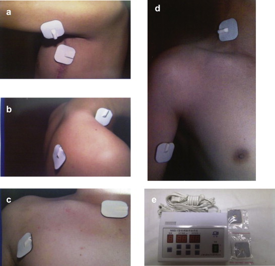 Accessory Nerve Injury Symptoms