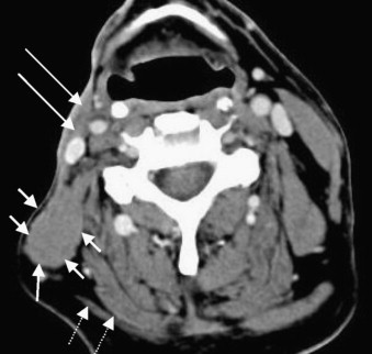 Accessory Nerve Injury Symptoms