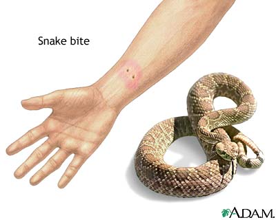 Adder Snake Bite Symptoms