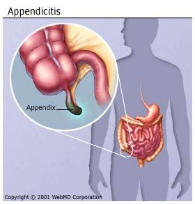 Appendix Location In Men