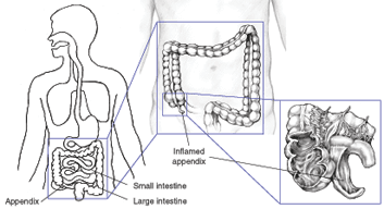 Appendix Location In Women