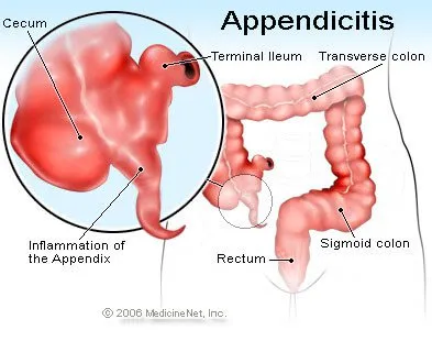 Appendix Location In Women