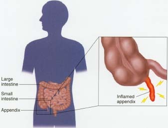 Appendix Location On Body