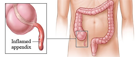 Appendix Location On Body