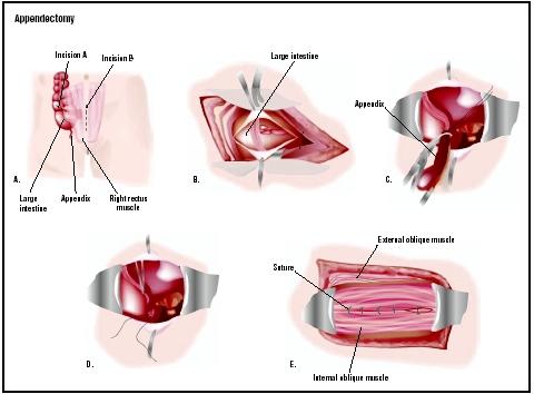 Appendix Operation