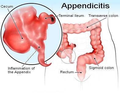 Appendix Operation Cost In India