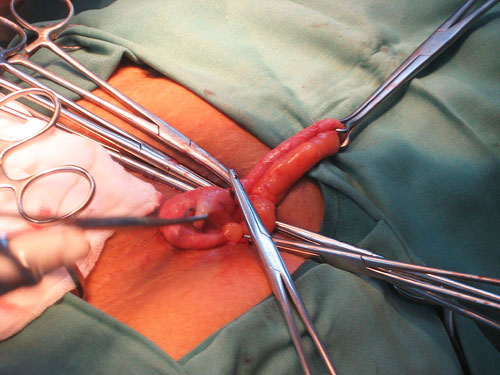 Appendix Pain Area