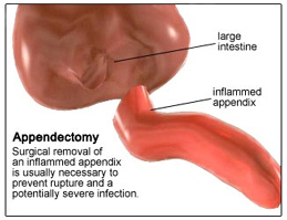 Appendix Removal Cost