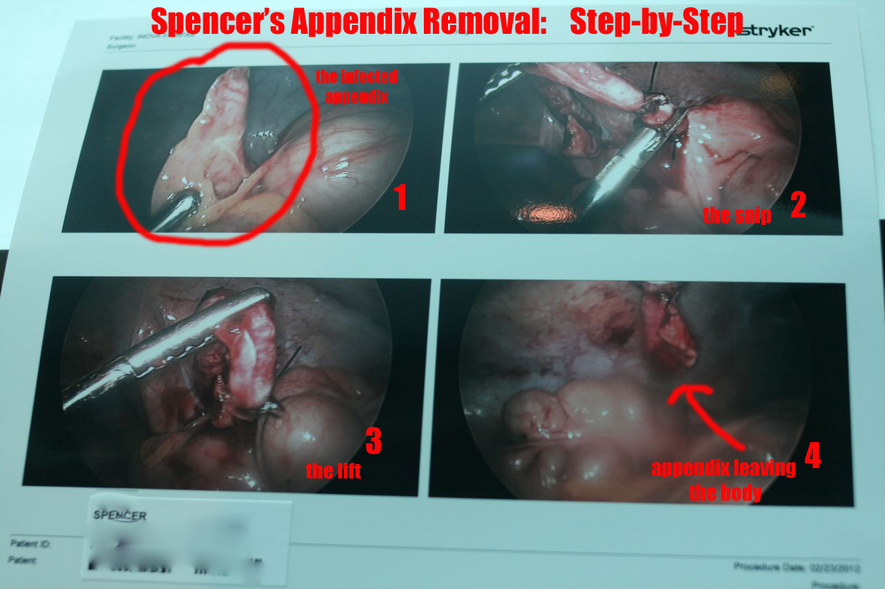 Appendix Removal Cost