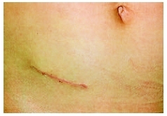 Appendix Removal Scar