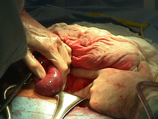 Appendix Removal Surgery