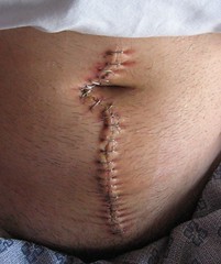 Appendix Removal Surgery