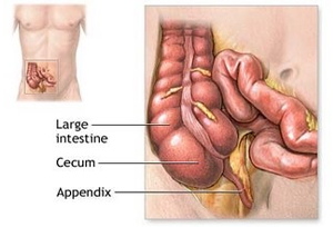 Appendix Removal Surgery