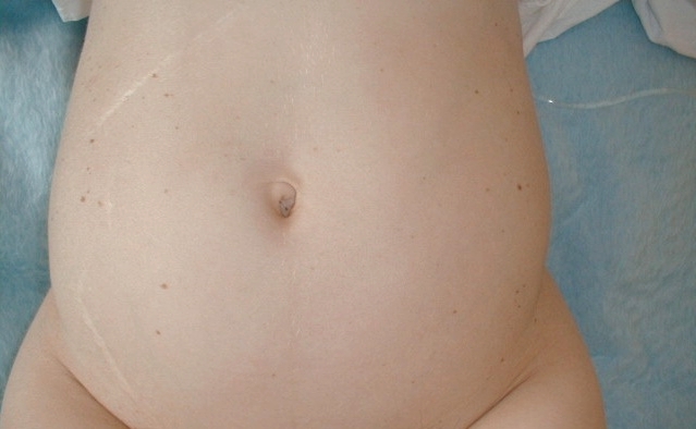 Appendix Scar