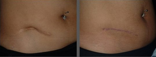 Appendix Scar Pain