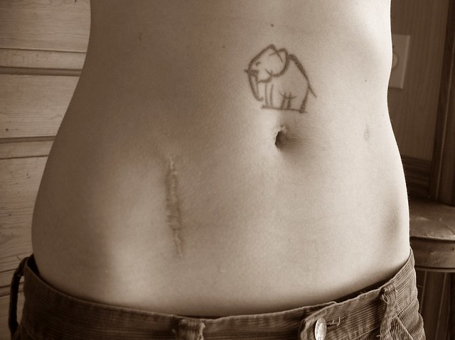 Appendix Scar Tattoo