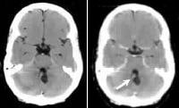 Autosomal Dominant Disorders Mnemonic