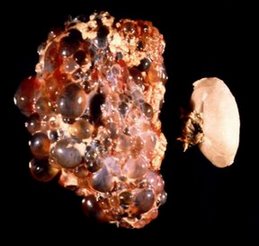 Autosomal Dominant Polycystic Kidney Disease The Last 3 Years