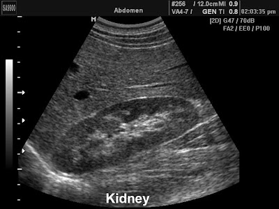 Autosomal Dominant Polycystic Kidney Disease Type 1