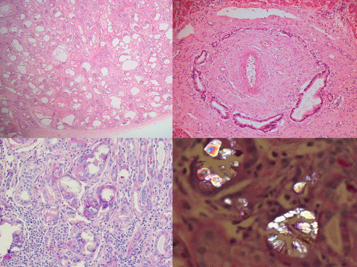 Autosomal Recessive Polycystic Kidney Disease Histology