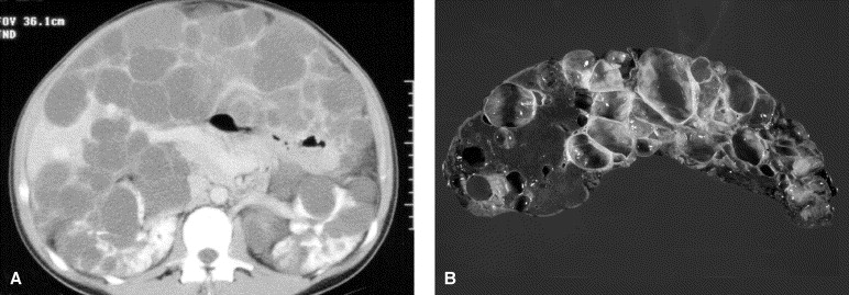 Autosomal Recessive Polycystic Kidney Disease Radiology