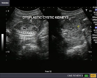 Autosomal Recessive Polycystic Kidney Disease Ultrasound