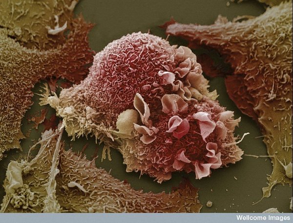 Cancer Cells Pictures