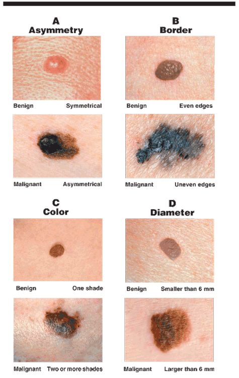 Cancerous Moles Images