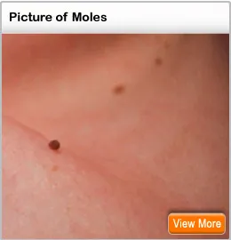 Cancerous Moles On Scalp