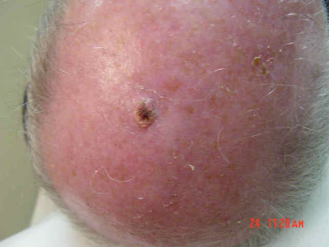 Cancerous Moles On Scalp