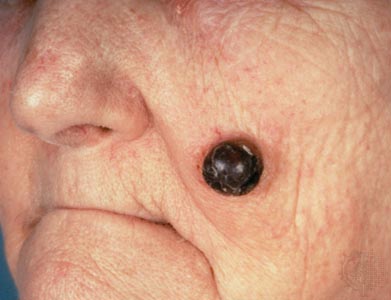 Cancerous Moles Symptoms And Signs