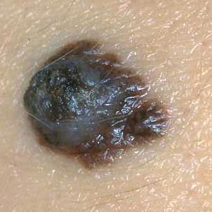Cancerous Moles Symptoms And Signs