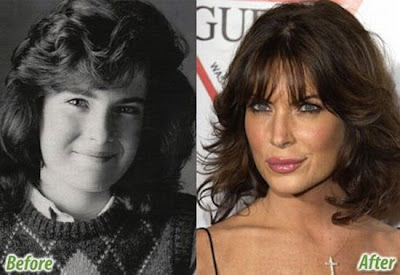 Celebs Before And After Plastic Surgery Pics