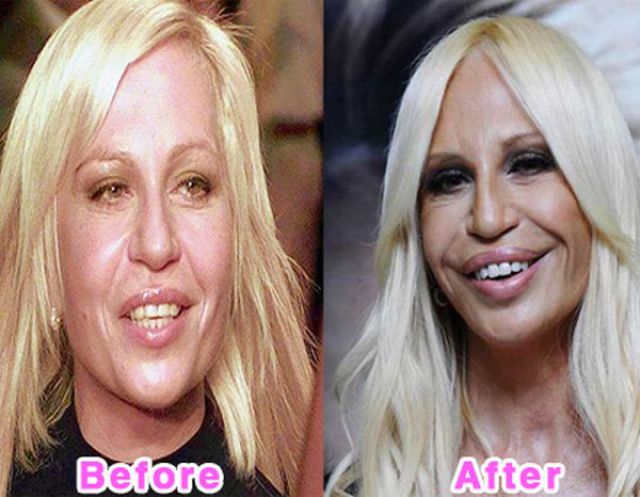 Celebs Before And After Plastic Surgery Pics