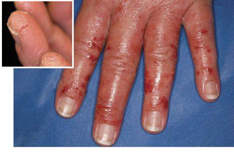 Contact Dermatitis Blisters