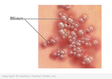 Contact Dermatitis Blisters