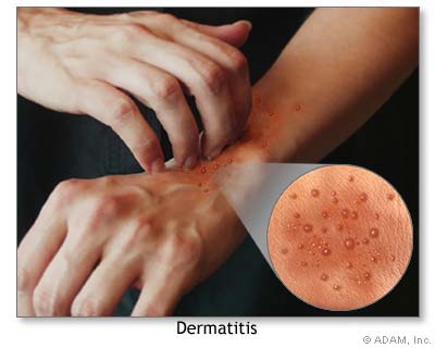 Contact Dermatitis Blisters
